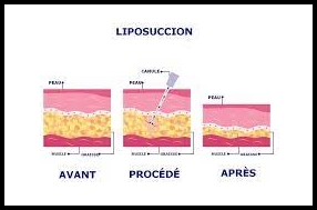 Tout savoir sur la pratique de la liposuccion !